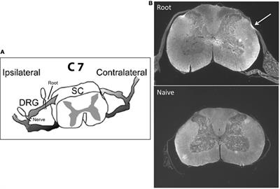 Developmental Changes in Pain and Spinal Immune Gene Expression after Radicular Trauma in the Rat